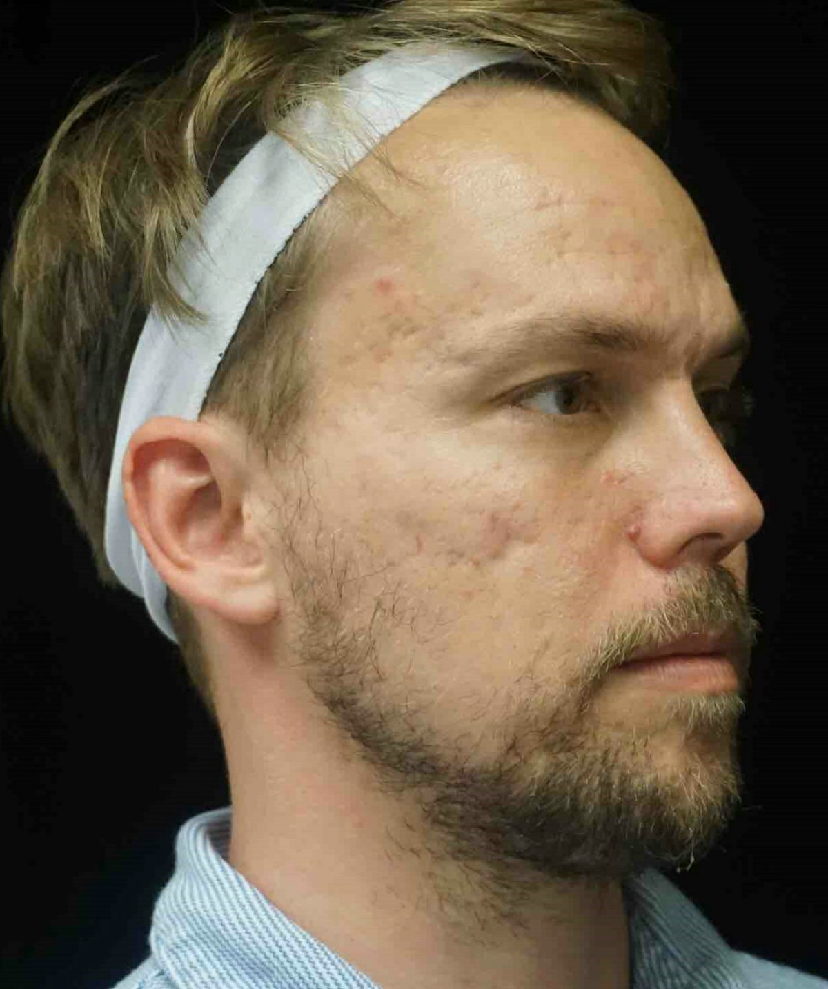 Subcision Before & After Gallery - Patient 181669 - Image 5