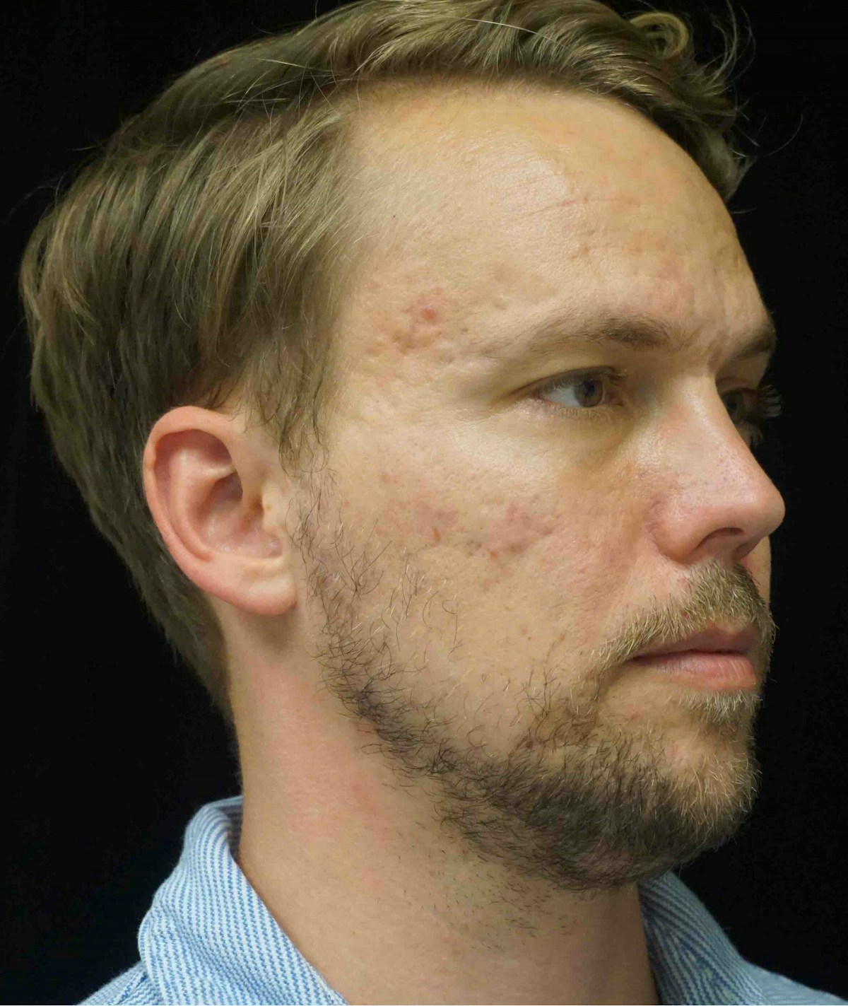 Subcision Before & After Gallery - Patient 181669 - Image 6