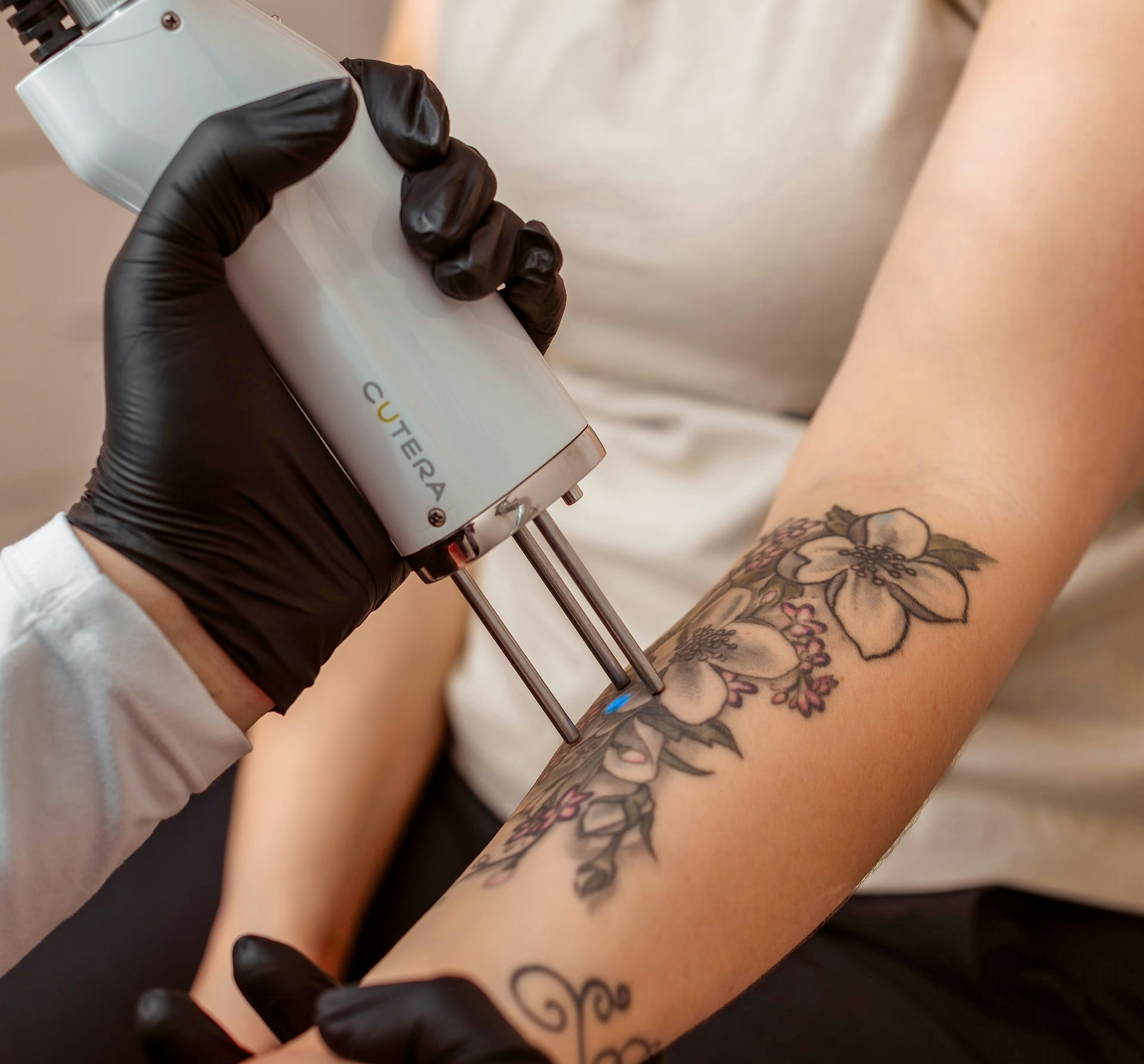 woman getting laser tattoo removal