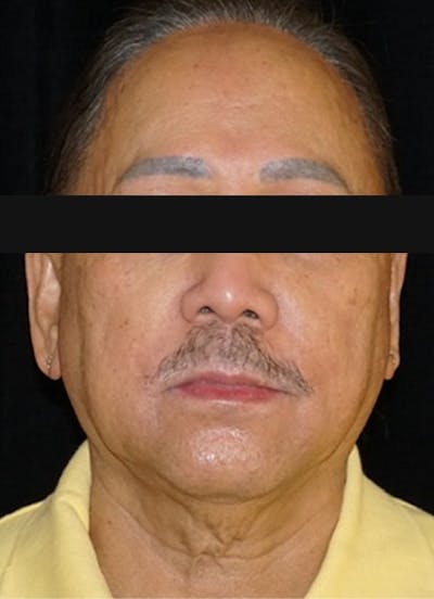 Accutane Before & After Gallery - Patient 130307 - Image 2