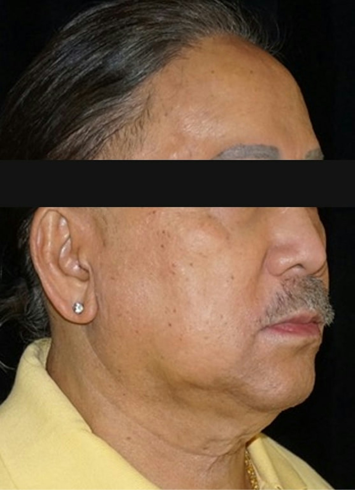 Accutane Before & After Gallery - Patient 130307 - Image 4