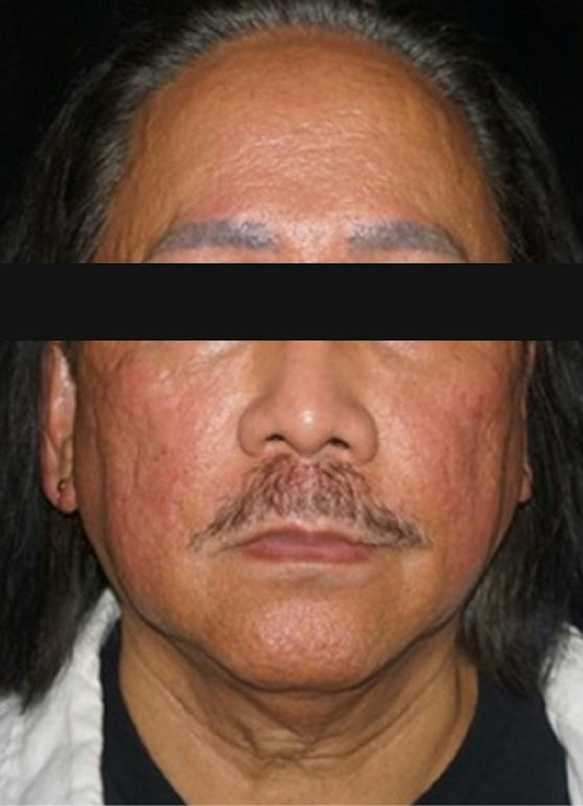 Accutane Before & After Gallery - Patient 130307 - Image 1