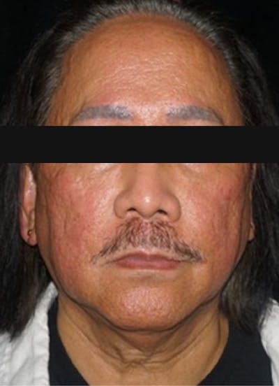 Accutane Before & After Gallery - Patient 130307 - Image 1
