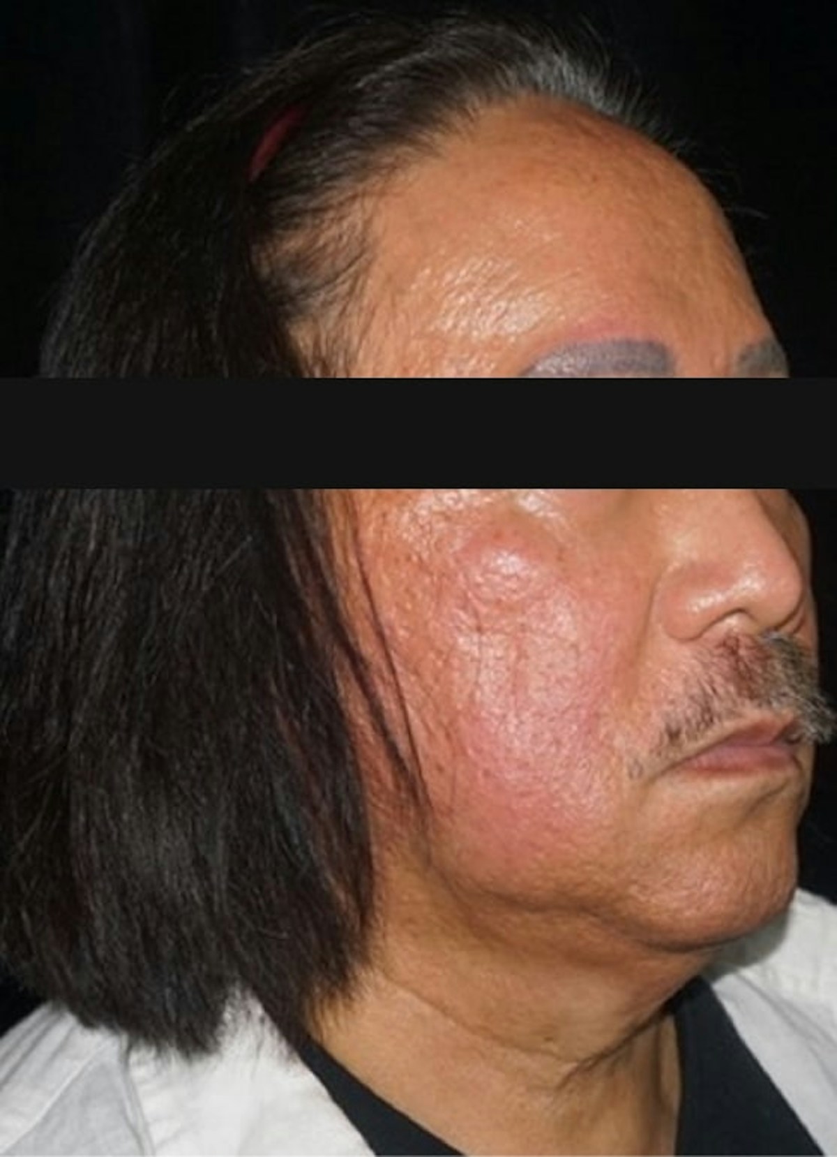 Accutane Before & After Gallery - Patient 130307 - Image 3