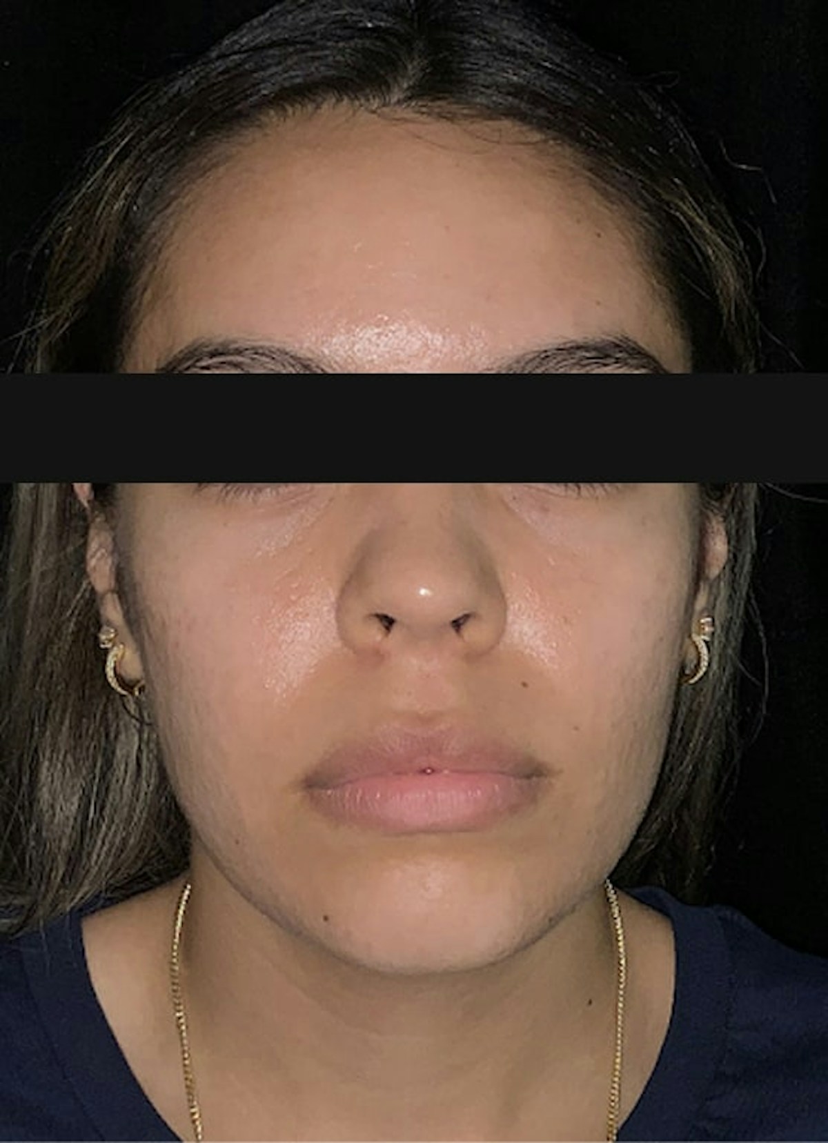 Accutane Before & After Gallery - Patient 271456 - Image 2