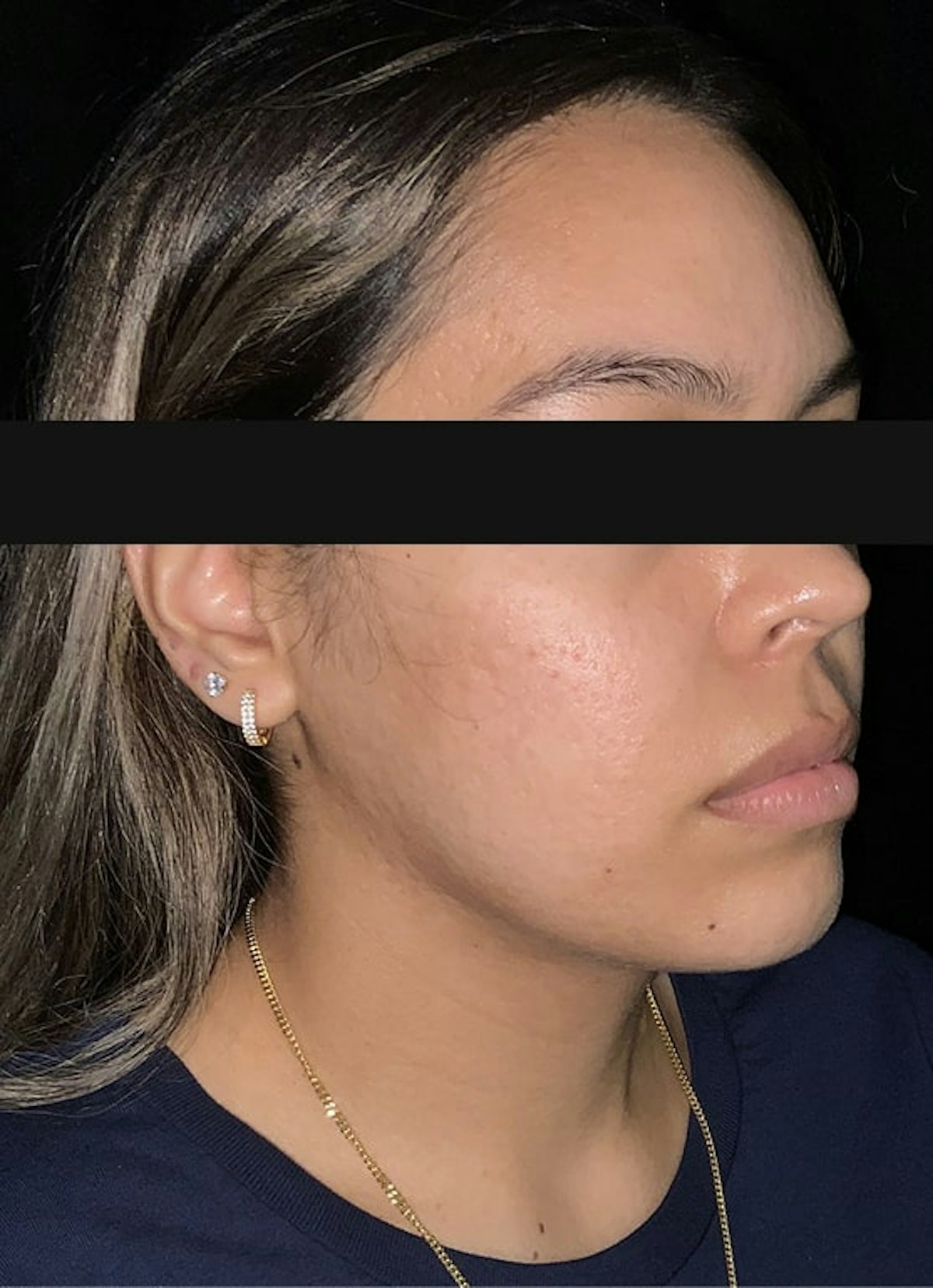 Accutane Before & After Gallery - Patient 271456 - Image 6