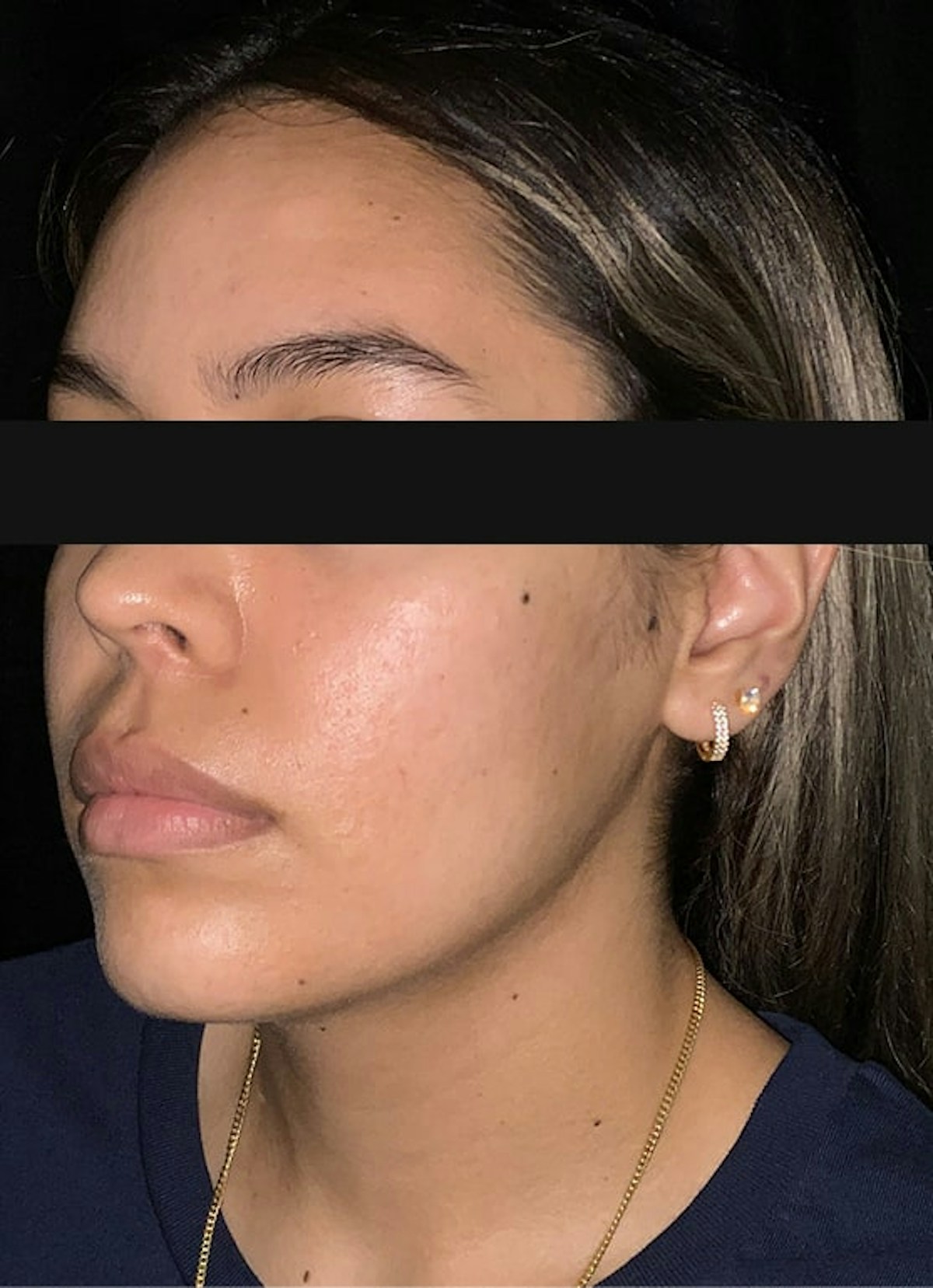 Accutane Before & After Gallery - Patient 271456 - Image 4