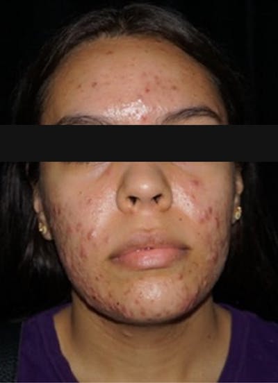 Accutane Before & After Gallery - Patient 271456 - Image 1