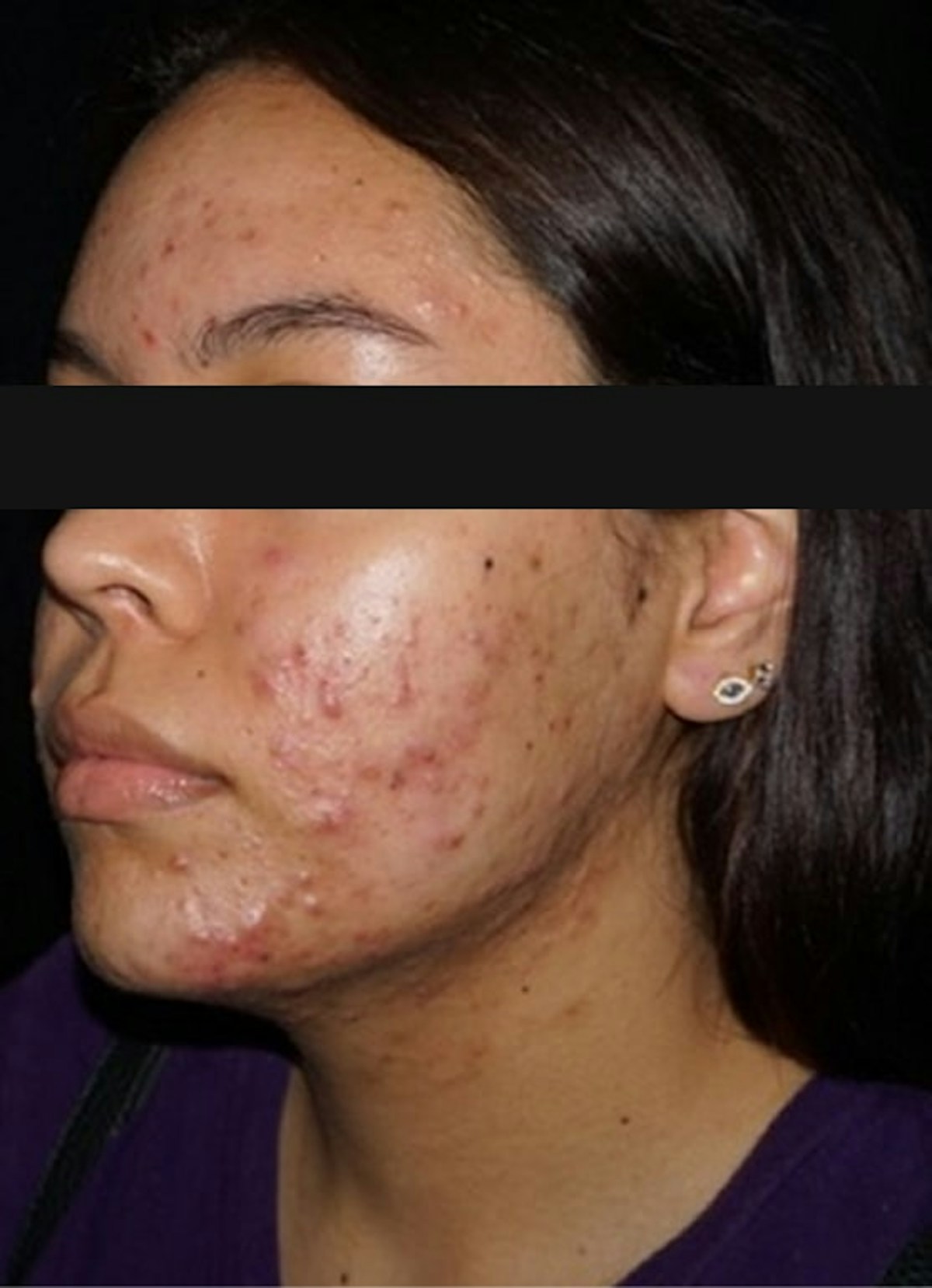 Accutane Before & After Gallery - Patient 271456 - Image 3