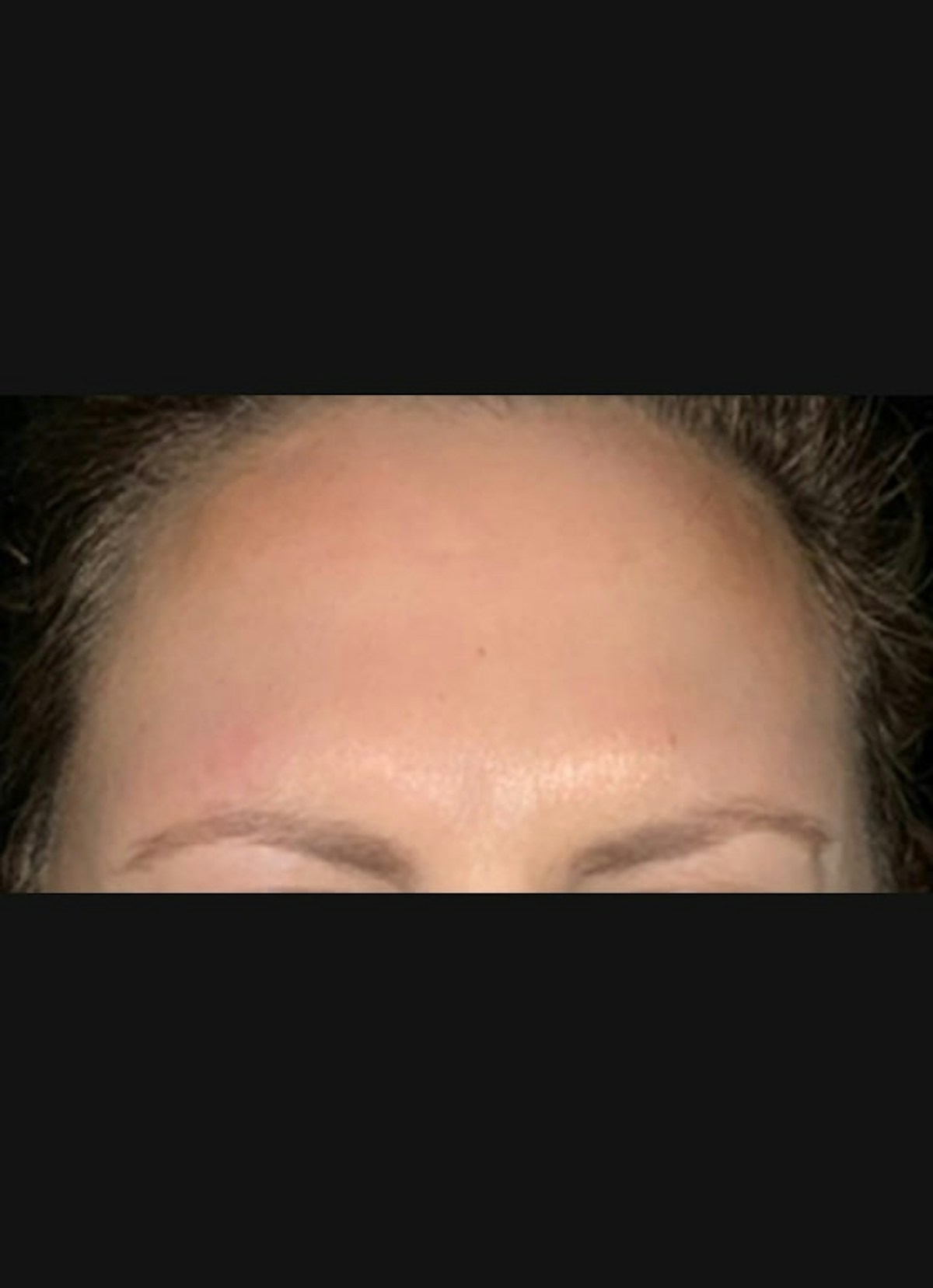 Botox Before & After Gallery - Patient 855627 - Image 2