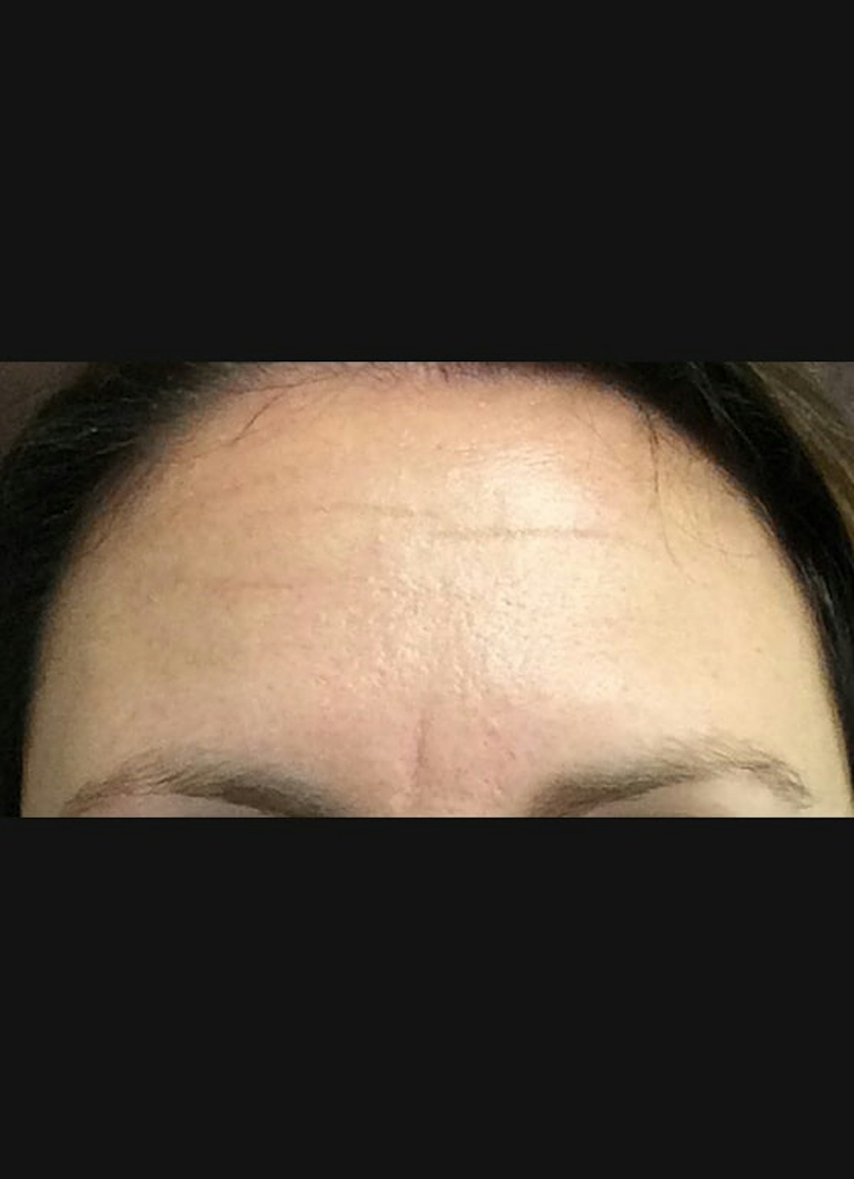 Botox Before & After Gallery - Patient 855627 - Image 1
