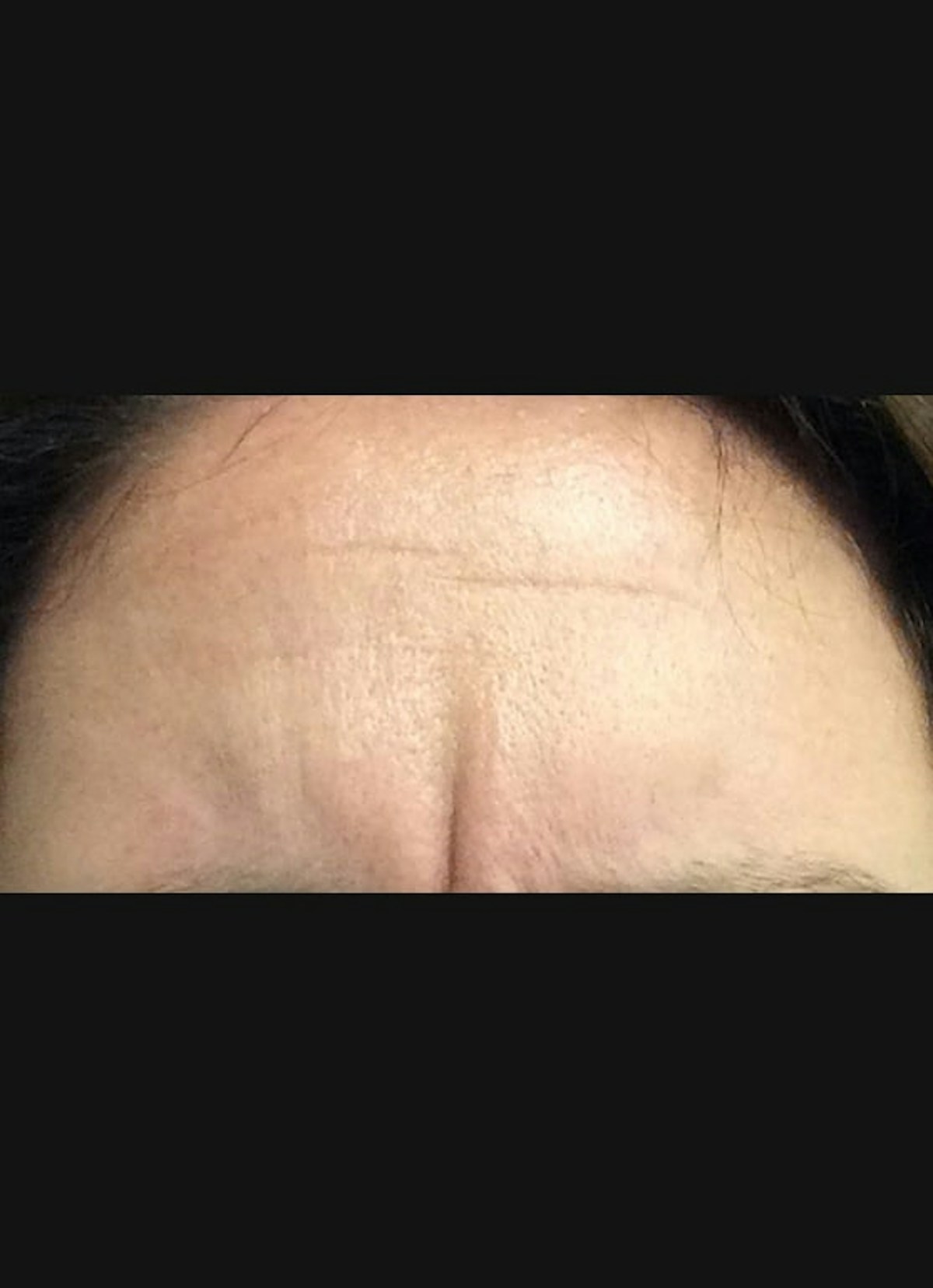 Botox Before & After Gallery - Patient 855627 - Image 3