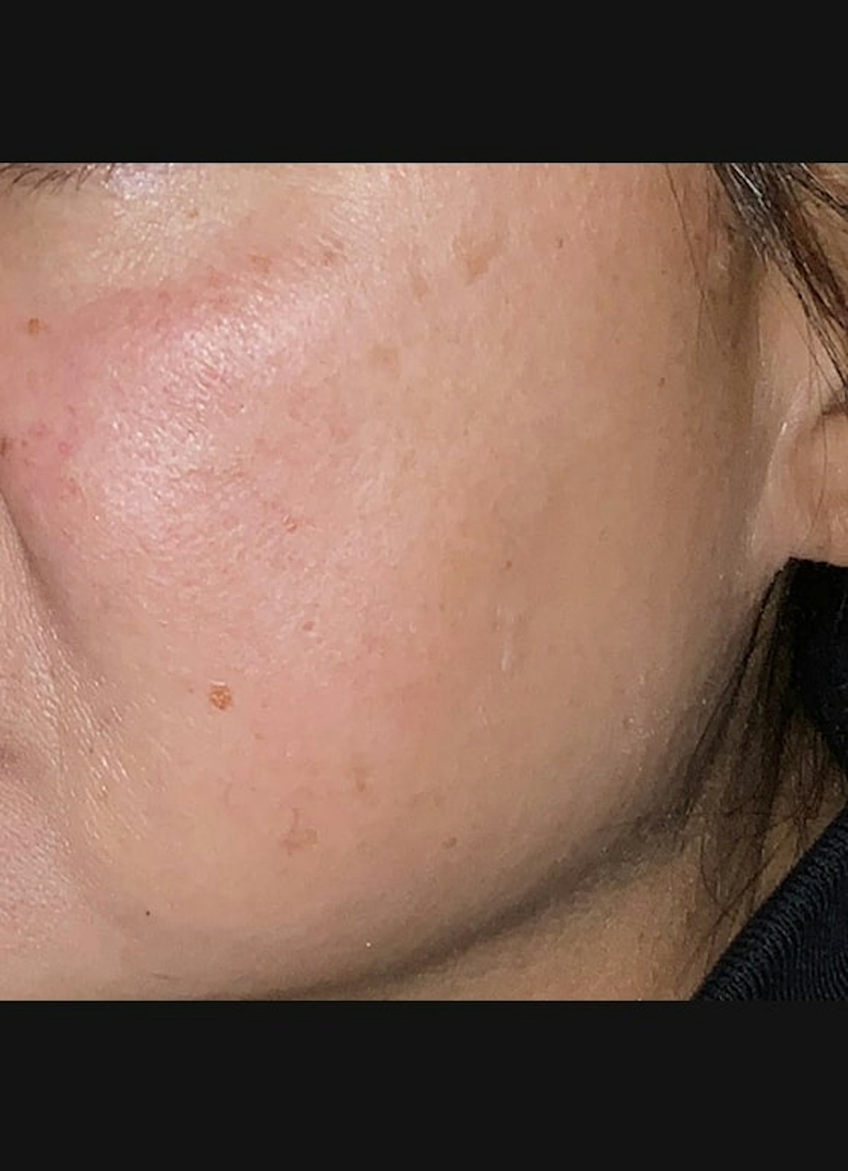 Chemical Peel Before & After Gallery - Patient 121045 - Image 2