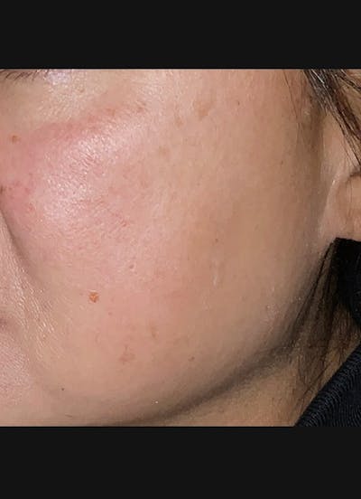 Chemical Peel Before & After Gallery - Patient 121045 - Image 2