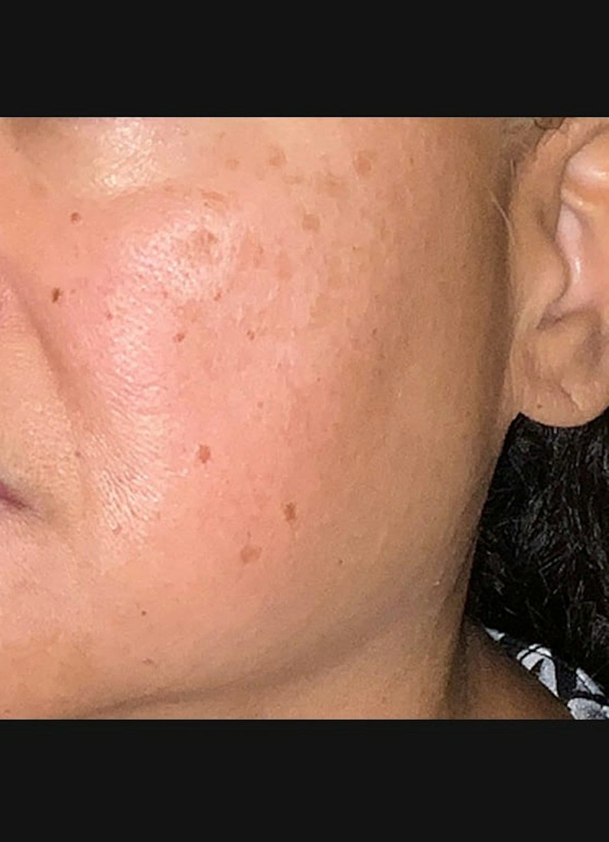 Chemical Peel Before & After Gallery - Patient 121045 - Image 1