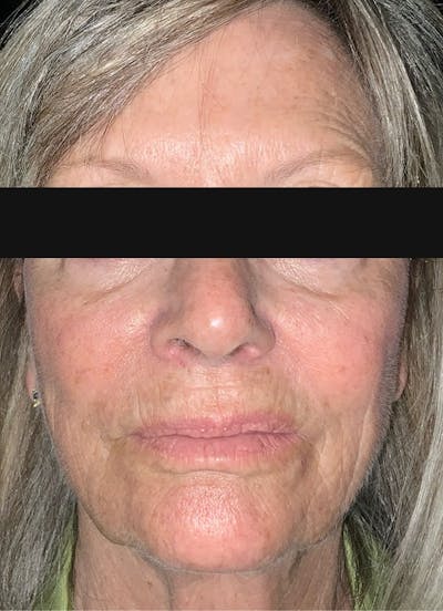 Filler and Botox Before & After Gallery - Patient 885797 - Image 2