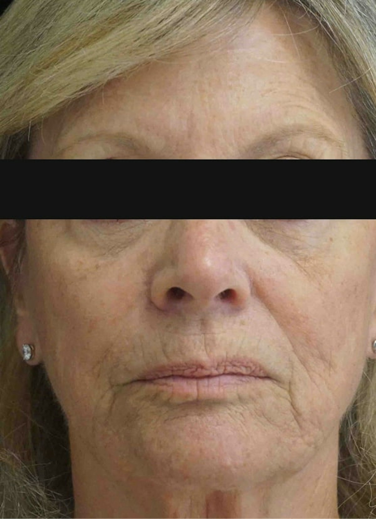 Filler and Botox Before & After Gallery - Patient 885797 - Image 1
