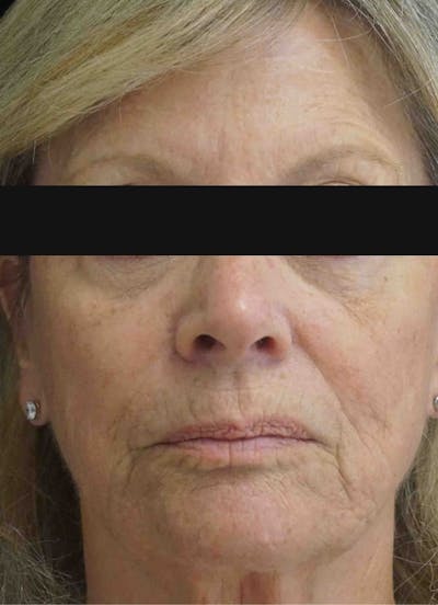Filler and Botox Before & After Gallery - Patient 885797 - Image 1