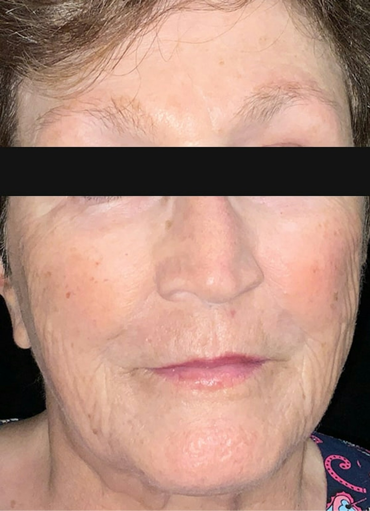 Filler & Excel V Before & After Gallery - Patient 135823 - Image 2