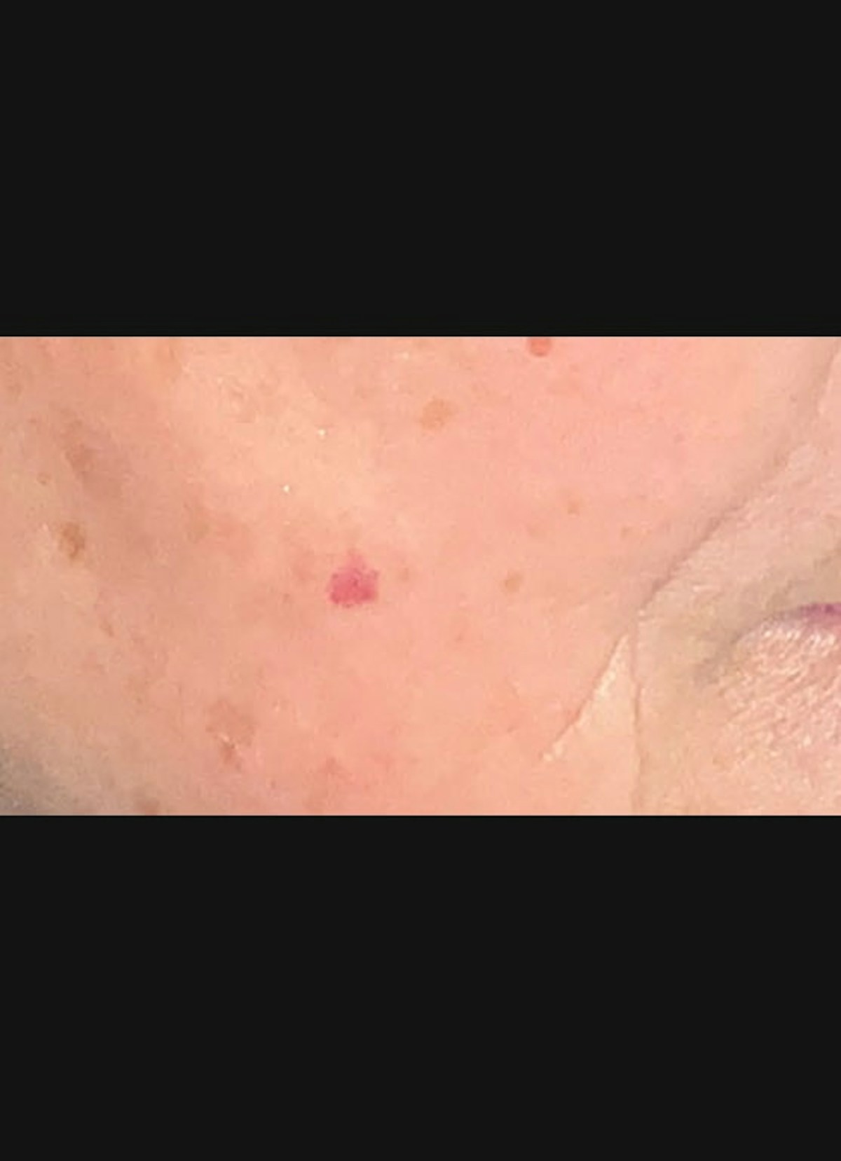 Filler & Excel V Before & After Gallery - Patient 135823 - Image 3