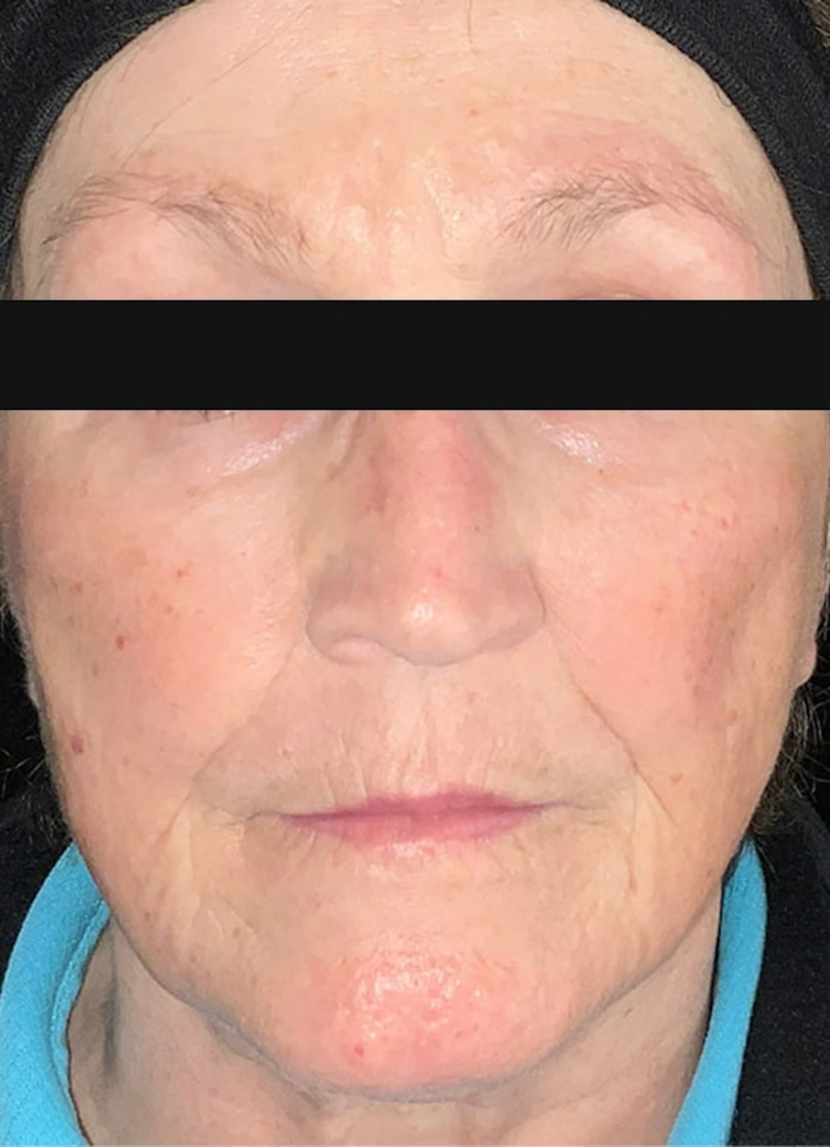 Filler & Excel V Before & After Gallery - Patient 135823 - Image 1