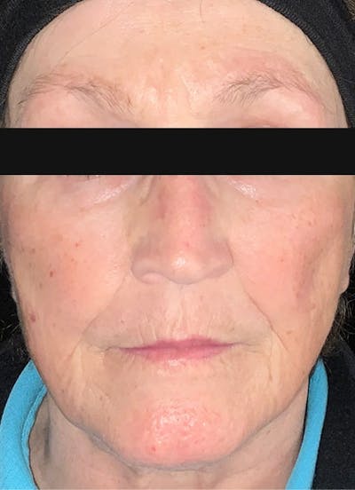 Filler & Excel V Before & After Gallery - Patient 135823 - Image 1