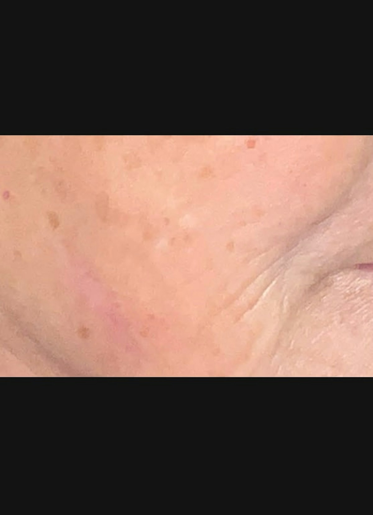 Filler & Excel V Before & After Gallery - Patient 135823 - Image 4