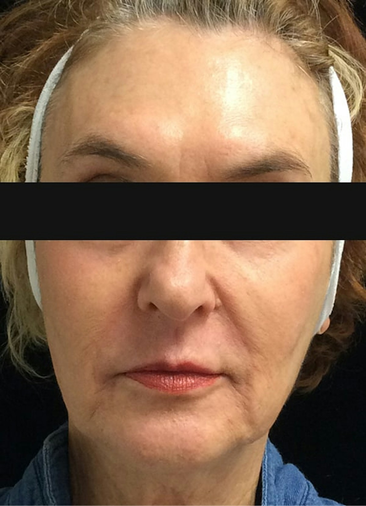 Halo, Filler & Botox Before & After Gallery - Patient 336157 - Image 2