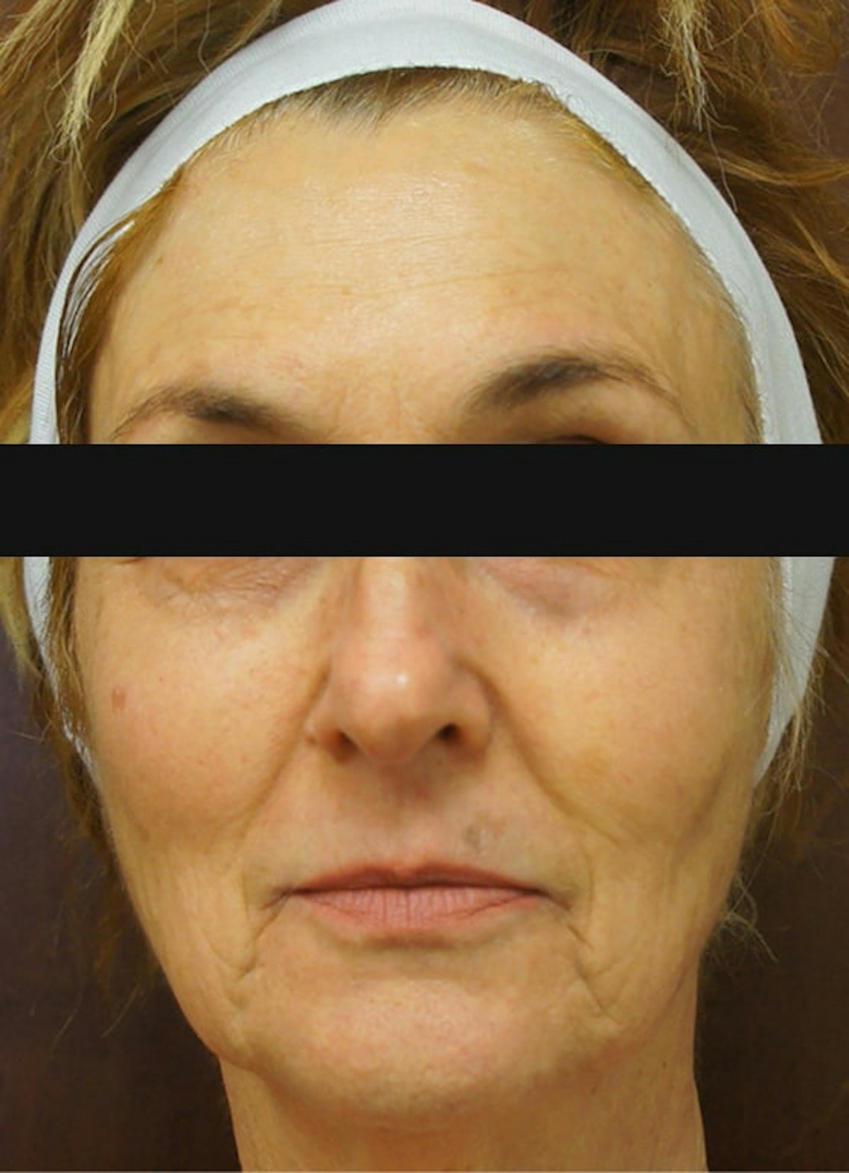 Halo, Filler & Botox Before & After Gallery - Patient 336157 - Image 1