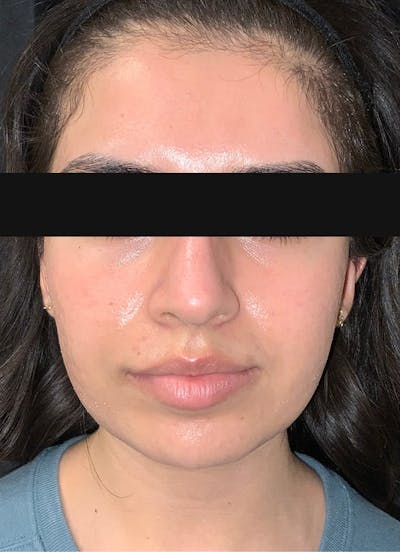 Virtue RF & CoolPeel Before & After Gallery - Patient 309534 - Image 2