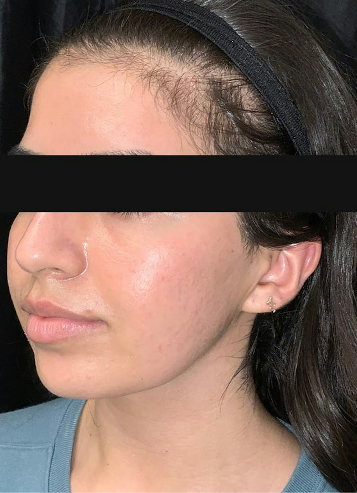 Virtue RF & CoolPeel Before & After Gallery - Patient 309534 - Image 6