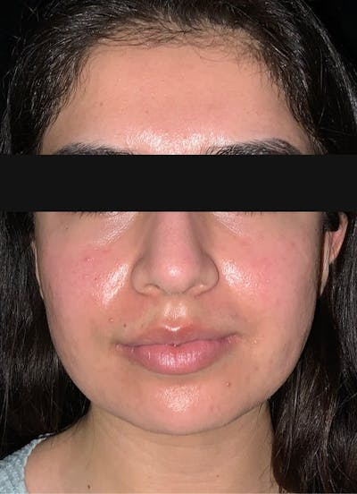 Virtue RF & CoolPeel Before & After Gallery - Patient 309534 - Image 1