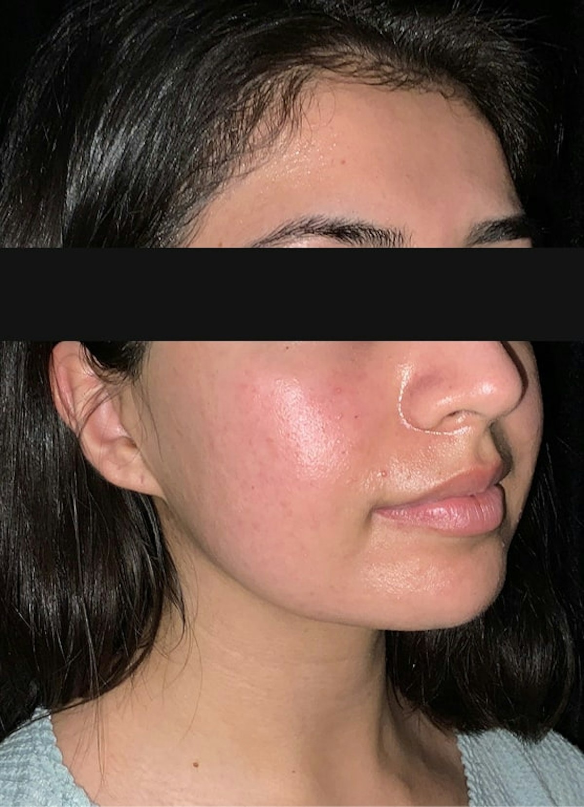 Virtue RF & CoolPeel Before & After Gallery - Patient 309534 - Image 3