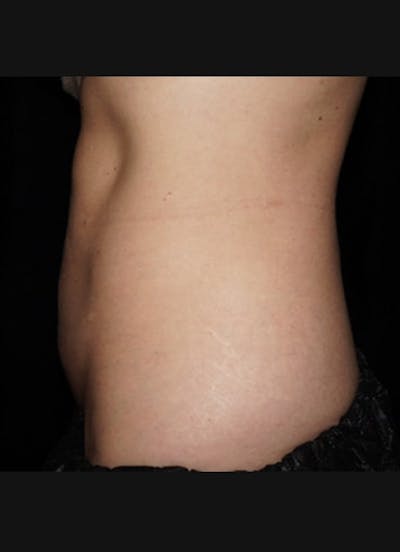 CoolSculpting Before & After Gallery - Patient 393879 - Image 2