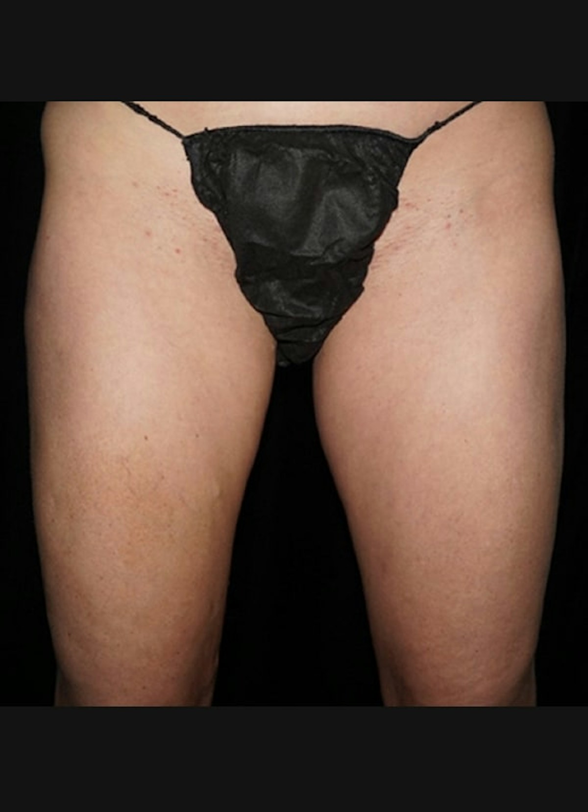 CoolSculpting Before & After Gallery - Patient 393879 - Image 4
