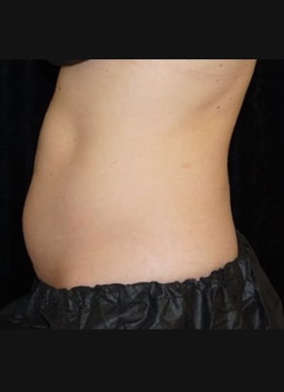 CoolSculpting Before & After Gallery - Patient 393879 - Image 1