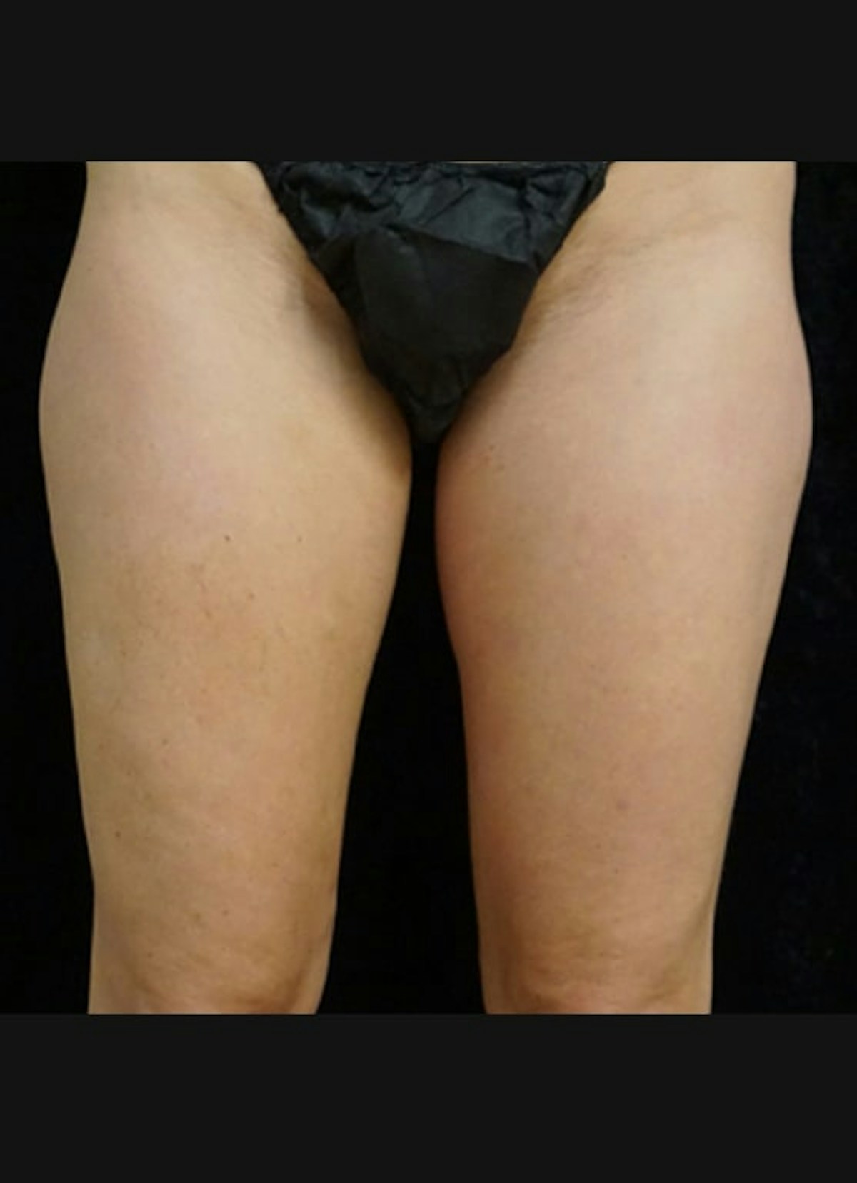 CoolSculpting Before & After Gallery - Patient 393879 - Image 3