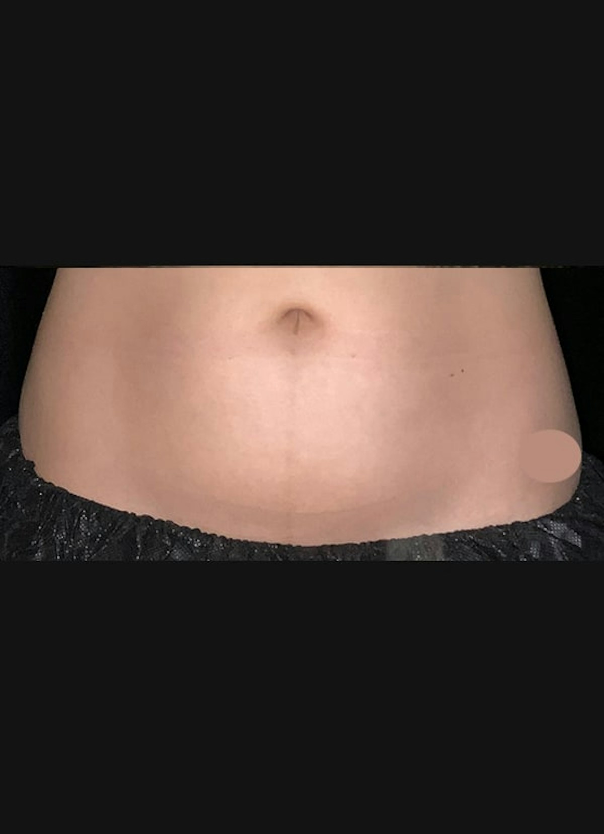 CoolSculpting Before & After Gallery - Patient 383766 - Image 2
