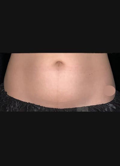 CoolSculpting Before & After Gallery - Patient 383766 - Image 2