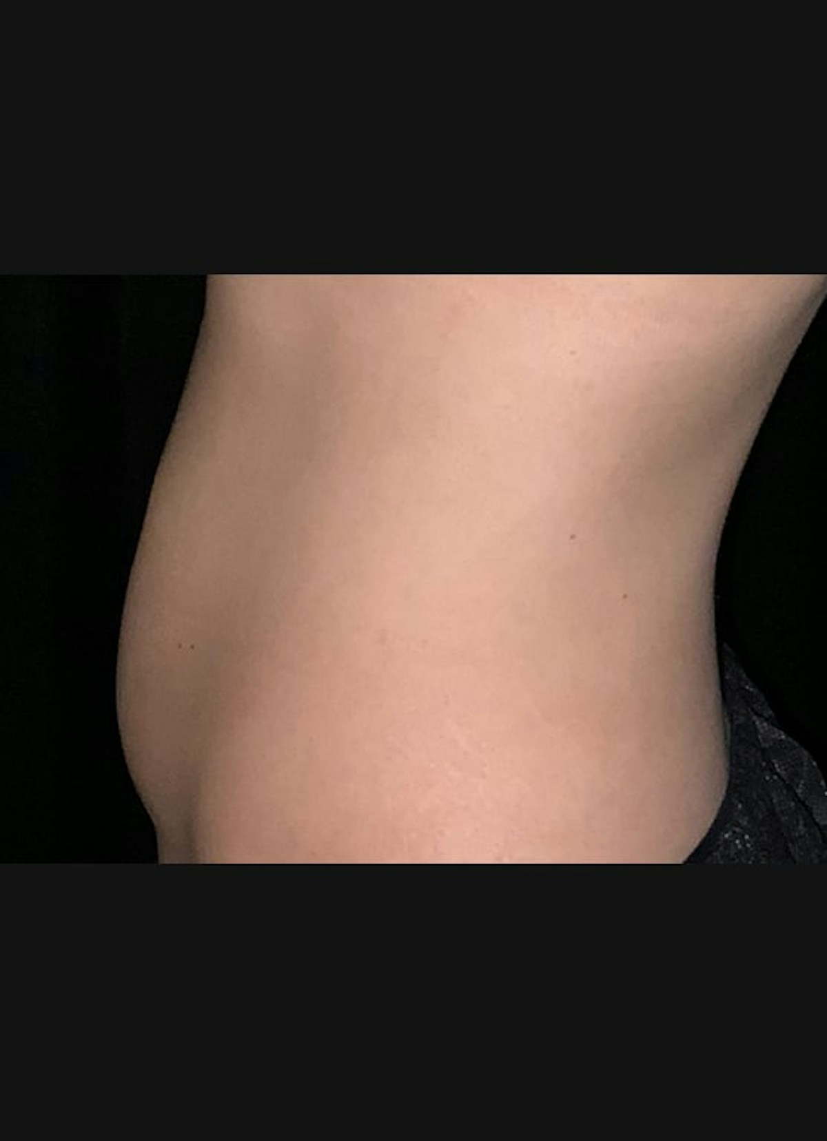 CoolSculpting Before & After Gallery - Patient 383766 - Image 4