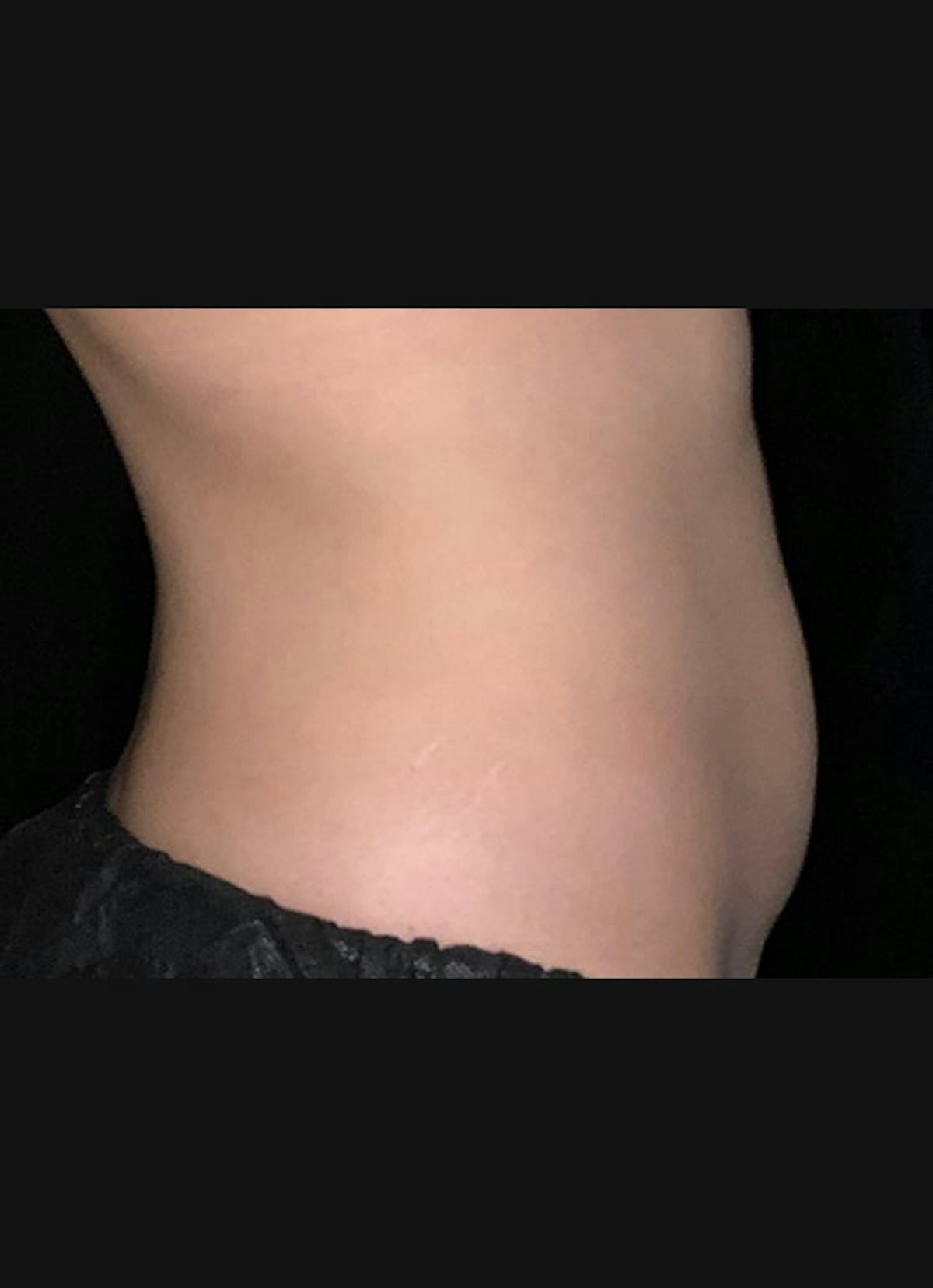 CoolSculpting Before & After Gallery - Patient 383766 - Image 6