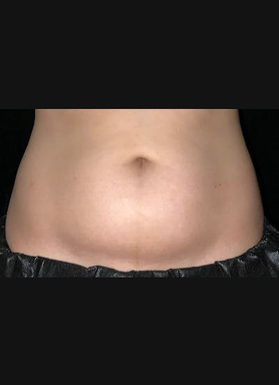 CoolSculpting Before & After Gallery - Patient 383766 - Image 1