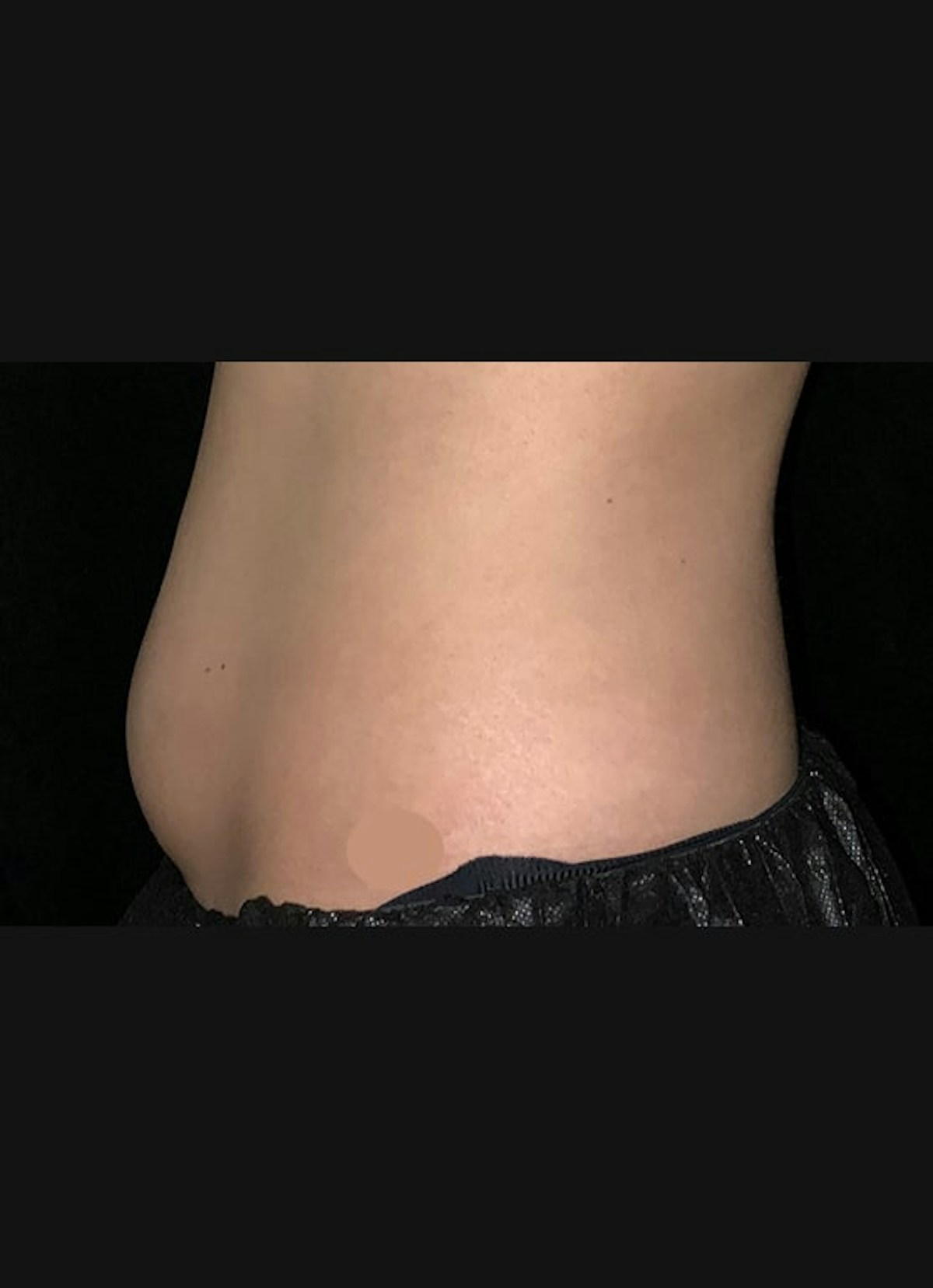 CoolSculpting Before & After Gallery - Patient 383766 - Image 3