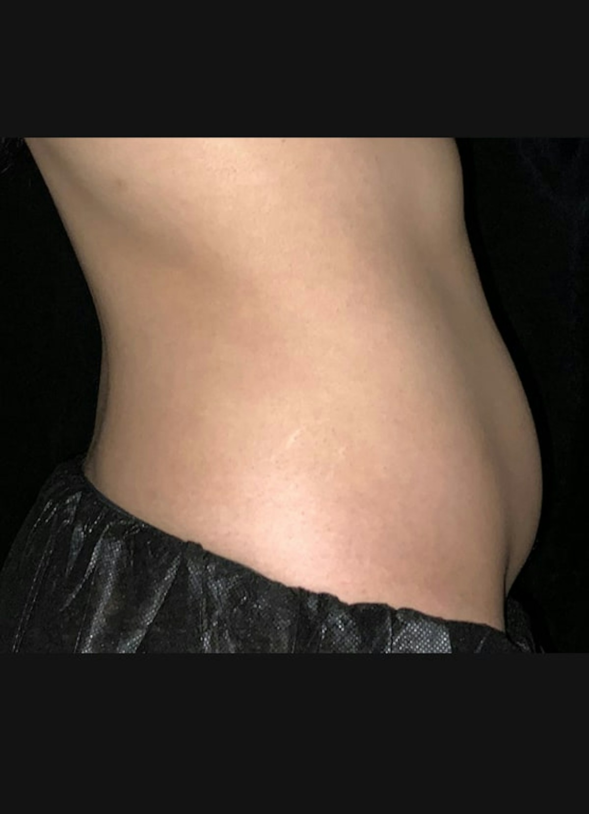 CoolSculpting Before & After Gallery - Patient 383766 - Image 5