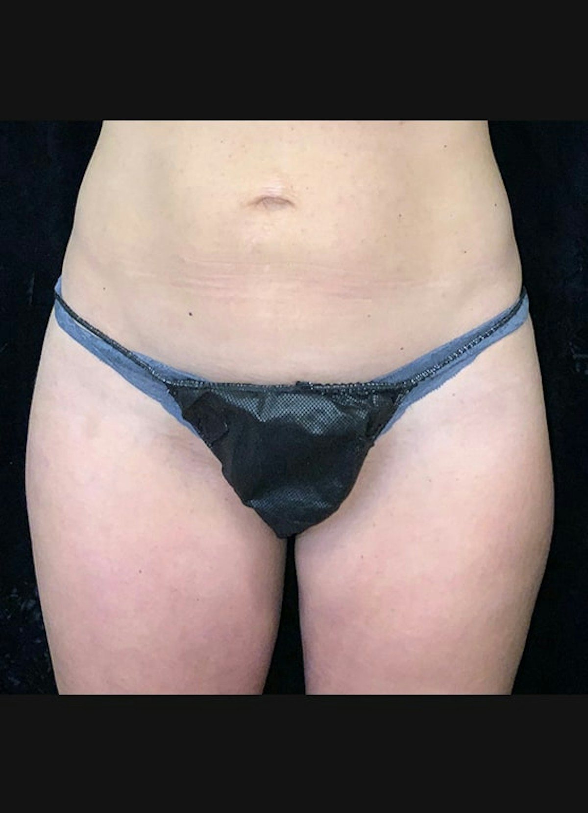 CoolSculpting Before & After Gallery - Patient 218891 - Image 2