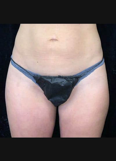 CoolSculpting Before & After Gallery - Patient 218891 - Image 2