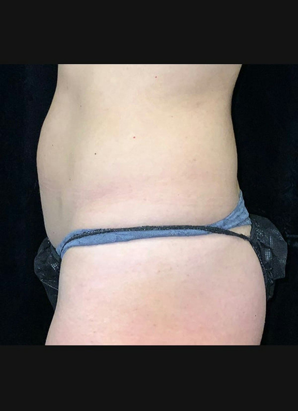CoolSculpting Before & After Gallery - Patient 218891 - Image 4