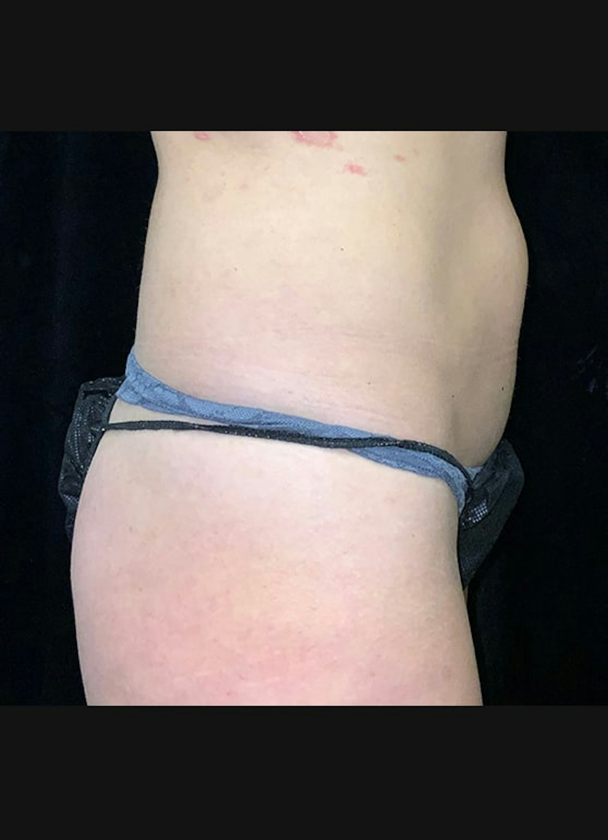 CoolSculpting Before & After Gallery - Patient 218891 - Image 6