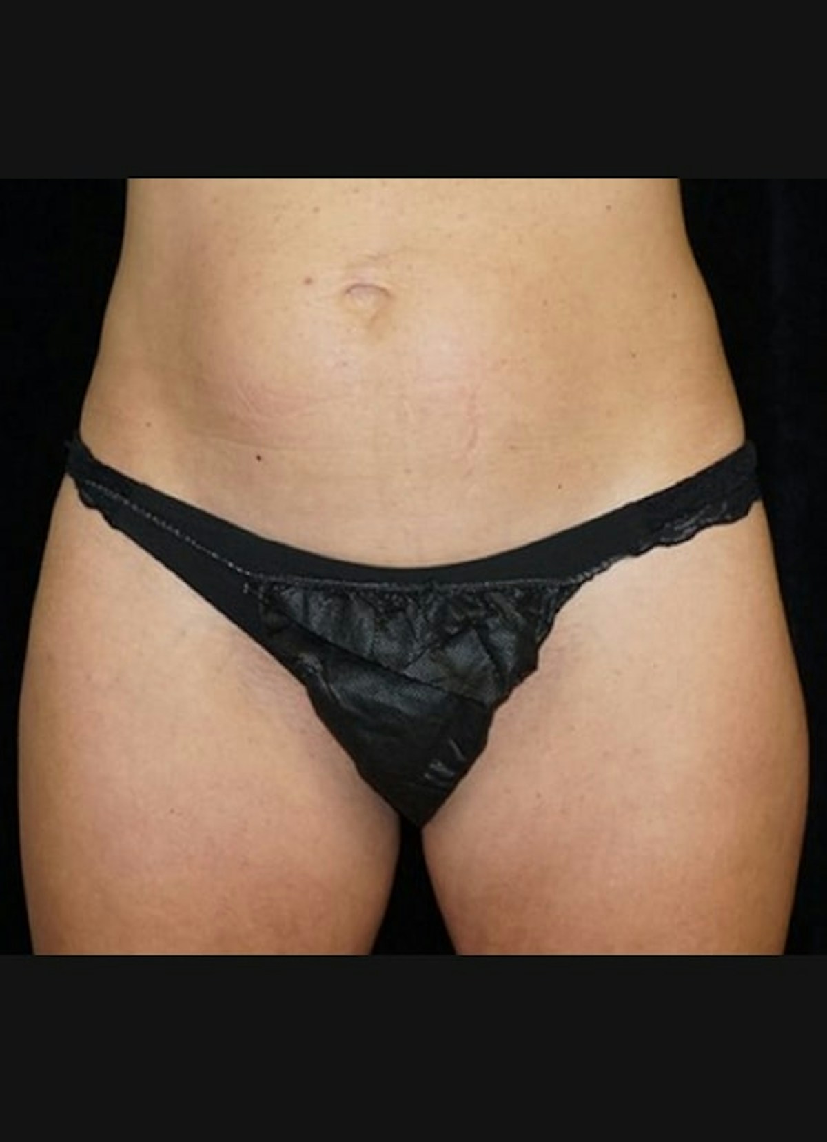CoolSculpting Before & After Gallery - Patient 218891 - Image 1