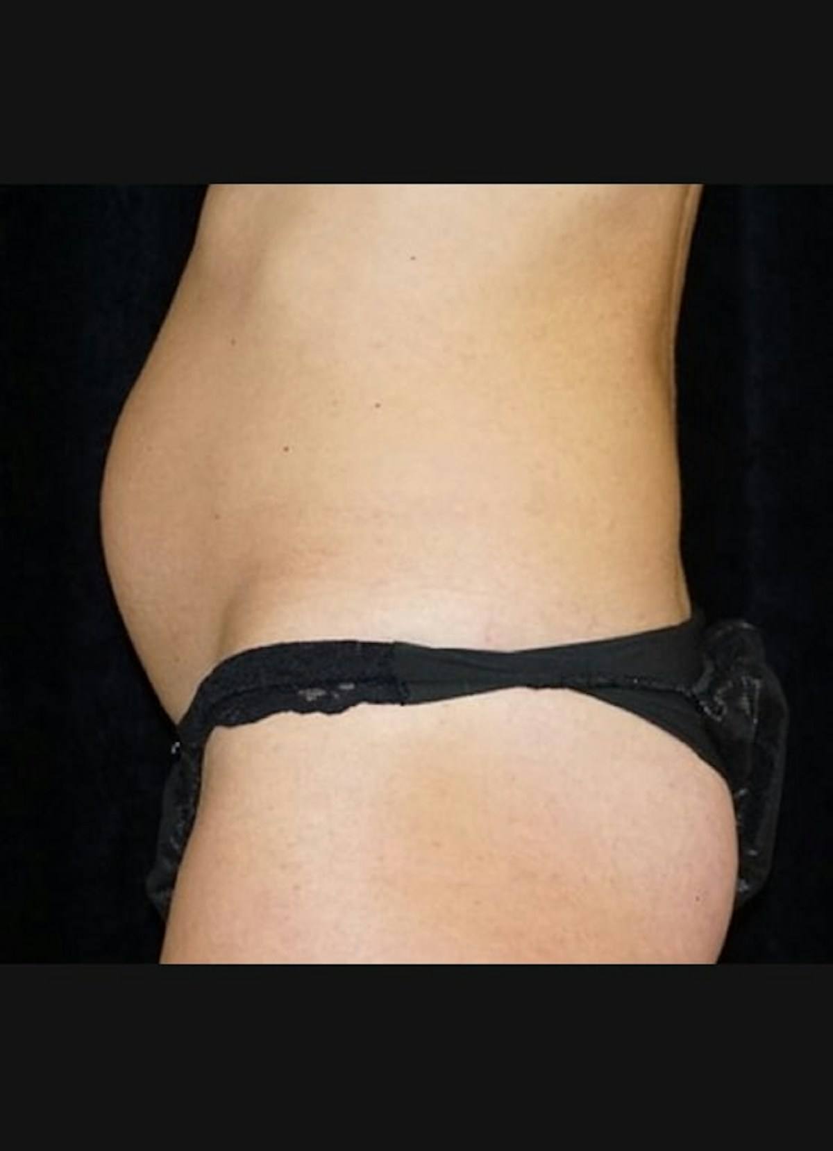CoolSculpting Before & After Gallery - Patient 218891 - Image 3